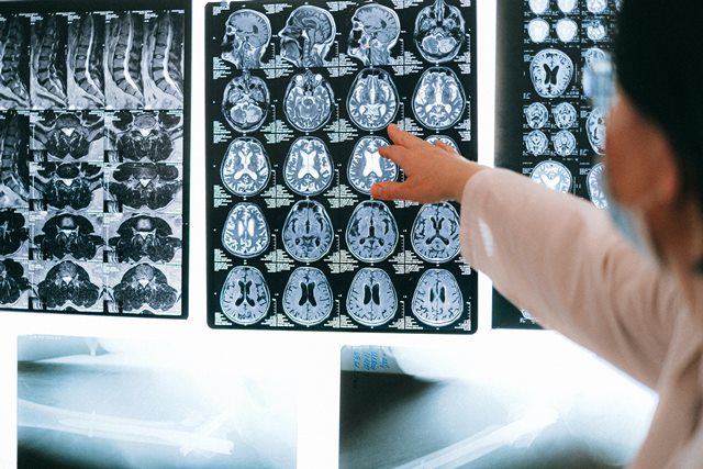 Menurut Dr. Dodik 60 persen dari seluruh kasus stroke mengenai penduduk di usia kurang dari 70 tahun. (Foto: Ilustrasi/Pexels.com)
