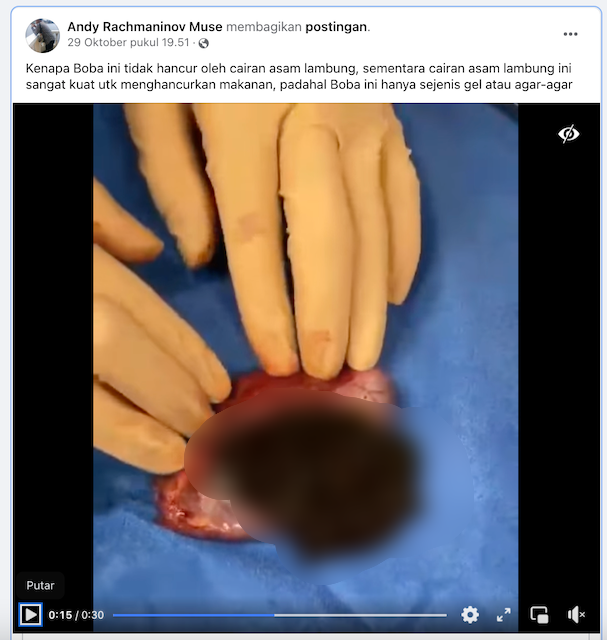 [Cek Fakta] Beredar Video Operasi Usus Buntu Mengeluarkan Boba? Ini Faktanya