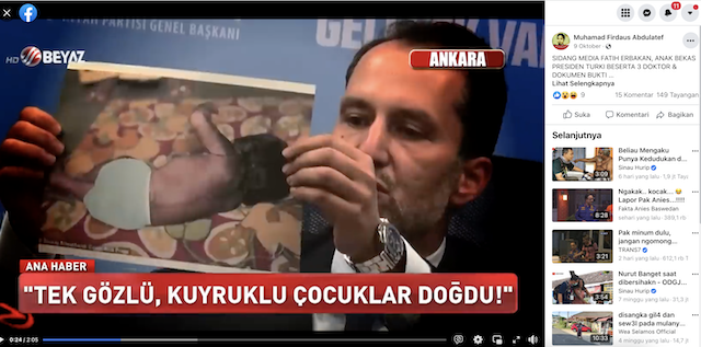 [Cek Fakta] Bayi Terlahir Cacat karena Ibunya Divaksin Covid-19 Saat Mengandung? Ini Faktanya