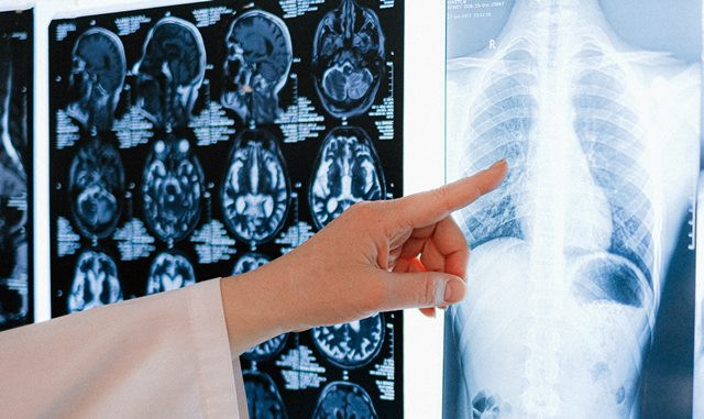 Kanker Paru di Indonesia Tak Hanya Disebabkan karena Perilaku Merokok