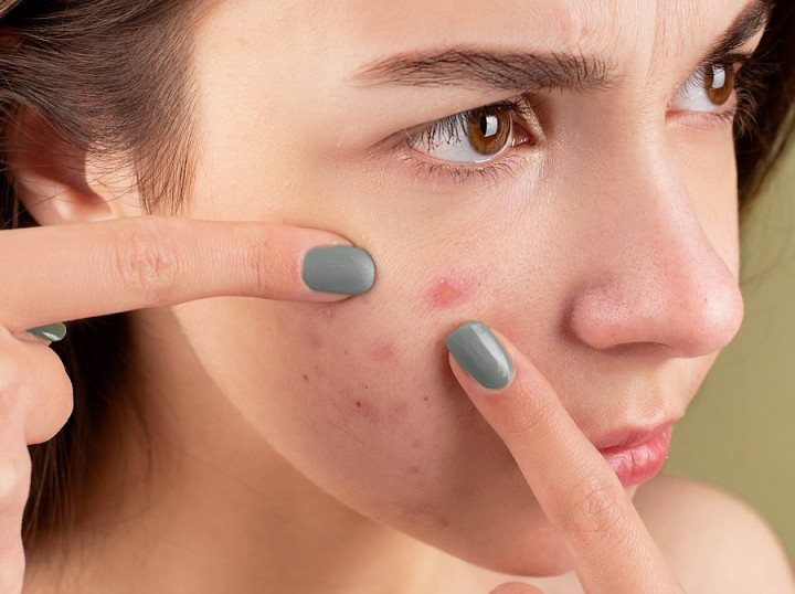 Atasi Jerawat Hingga Hapus Tato, Kenali Penggunaan Terapi Laser