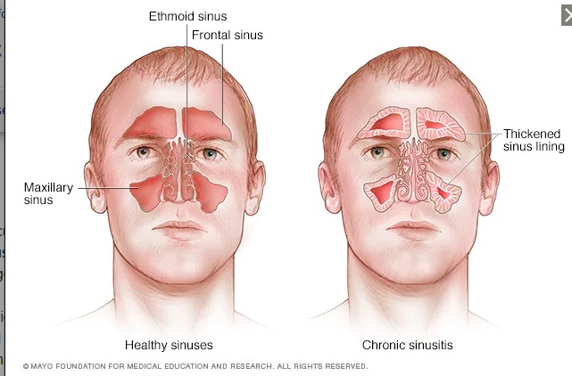 Ilustrasi-Mayo Clinic