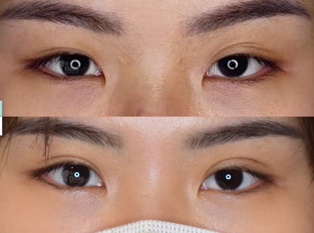 Hasil dari teknik Double Eyelid (Dok. Catherine Soebroto)