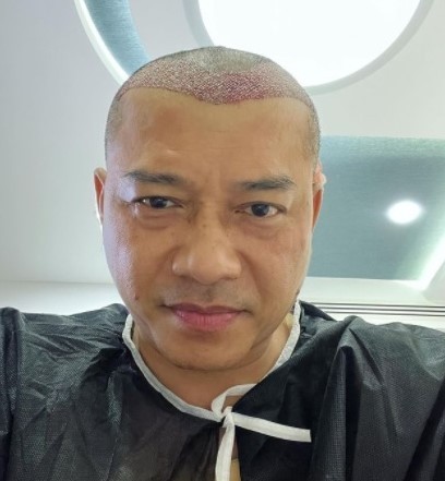 Anang Hermansyah memangkas habis rambut demi melakukan transplantasi rambut. Instagram @ananghijau.