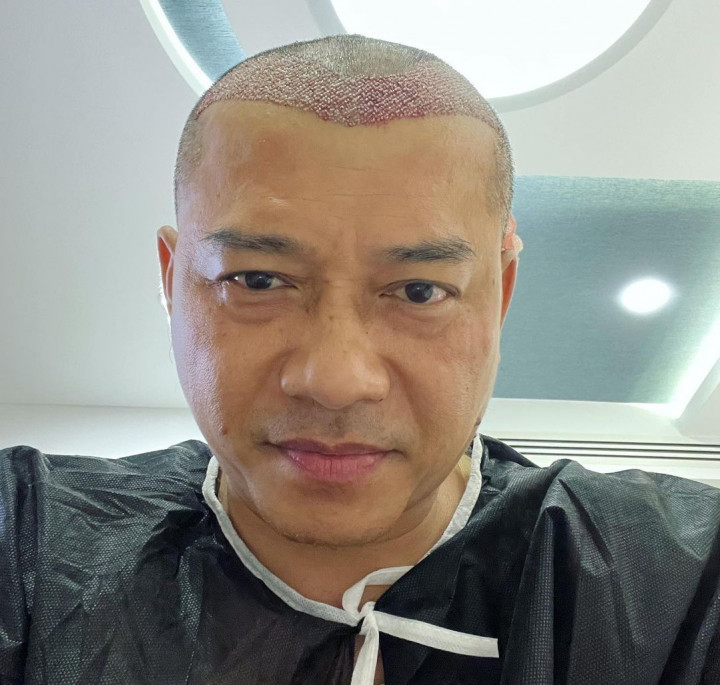 Anang Hermansyah Ungkap Proses Transplantasi Rambut di Turki