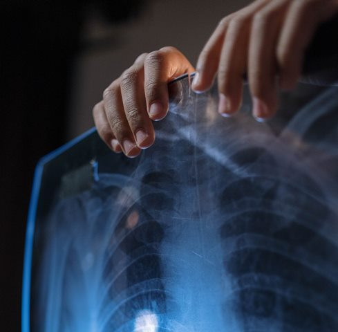 Ini jenis kerusakan akibat terjadinya cedera saraf tulang belakang (spinal cord injury). (Foto: Ilustrasi/Pexels.com)