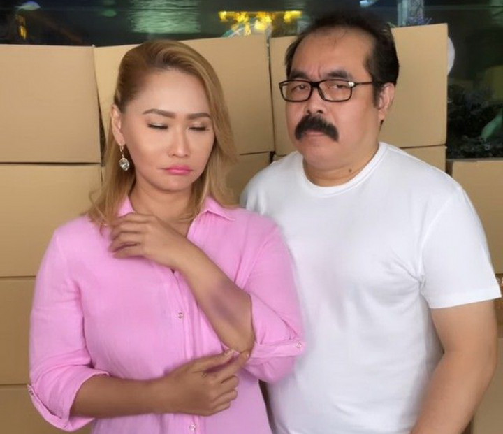 Pamer Lebam di Tangan, Inul Daratista Dikira Korban KDRT Adam Suseno