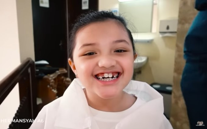 Arsy Pakai Behel Usia 7 Tahun, Ini Pertanda Anak Perlu Pakai Kawat Gigi