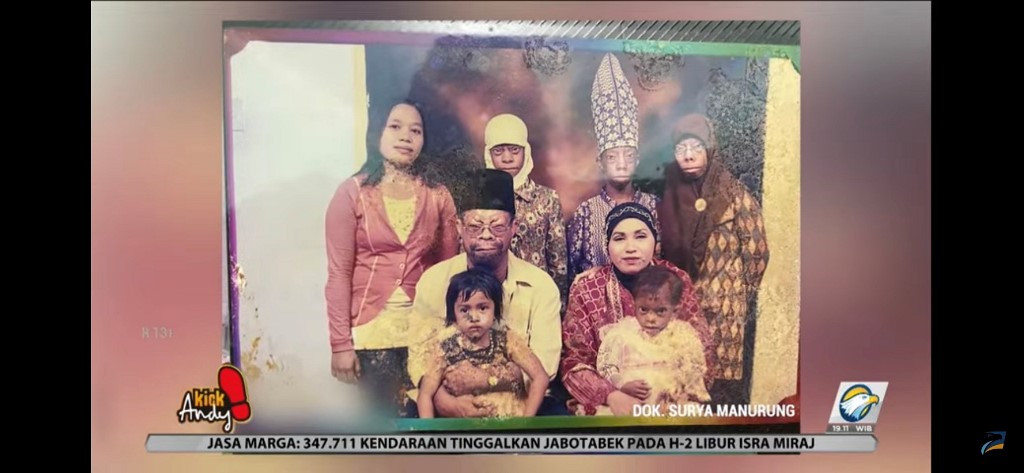 Potret keluarga Surya Manurung, penderita sindrom barber say. Foto: Kick Andy