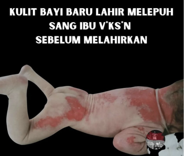 [Cek Fakta] Kulit Bayi Baru Lahir Melapuh karena Sang Ibu Divaksin Covid-19 Saat Hamil? Cek Dulu Faktanya