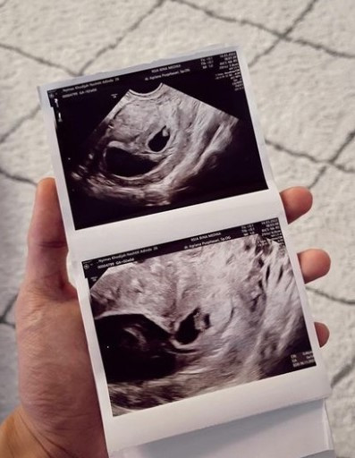 Dialami Dinda Hauw, Ini 5 Pertanda Keguguran yang Perlu Diketahui