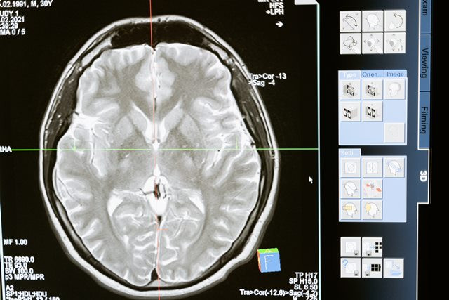 Satu sekolah di New Jersey dikabarkan terkena tumor otak. (Foto: Ilustrasi/Pexels.com)