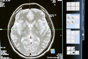 Mengkhawatirkan, Satu Sekolah dengan 100 Pasien Lebih Terkena Tumor Otak