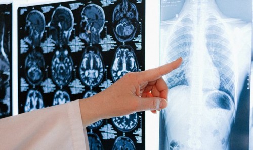 Mengenal Sel Kanker, Si ‘Pengecoh’ Sistem Imun dalam Tubuh Manusia