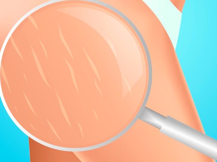 Stretch mark adalah guratan pada kulit berupa garis-garis. (Foto: Ilustrasi. Dok. Freepik.com)