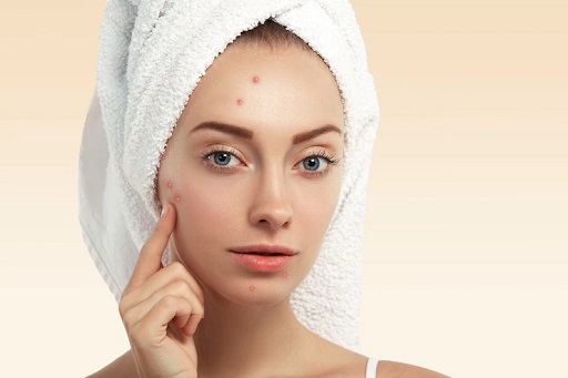 Ini Bedanya Jerawat pada Remaja vs Orang Dewasa dan Cara Mencegahnya