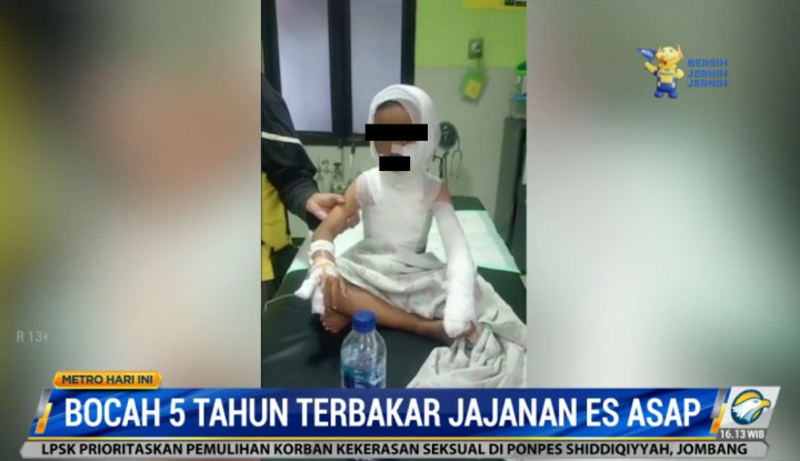 Bocah 5 Tahun Luka Bakar 30 Persen Akibat Terbakar Jajanan Es Asap