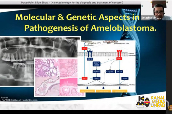 Mengenal Ameloblastoma, Tumor Rahang Jinak Namun Agresif