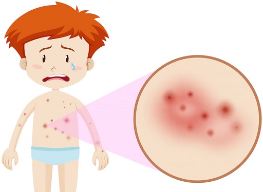 Eksem sering kali terjadi pada bayi dan anak-anak,. (Foto: Ilustrasi. Dok. Freepik.com)