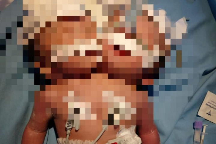 Terlahir Kembar Siam, Bayi di Pariaman Punya Dua Kepala dengan Satu Badan