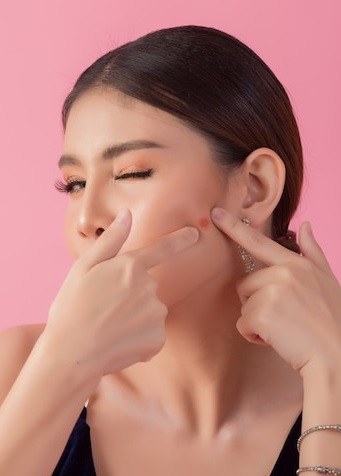 Bekas jerawat sering kali membuat kaum wanita jadi tidak percaya diri. (Foto: Ilustrasi. Dok. Freepik.com)