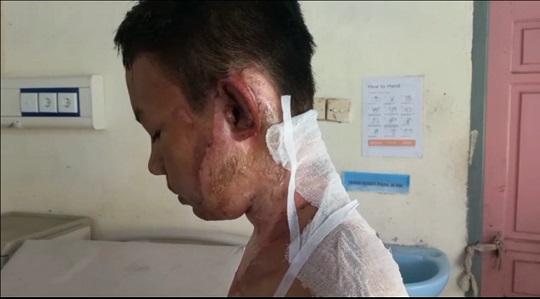 Kondisi Remaja yang Dibakar Hidup-hidup Membaik