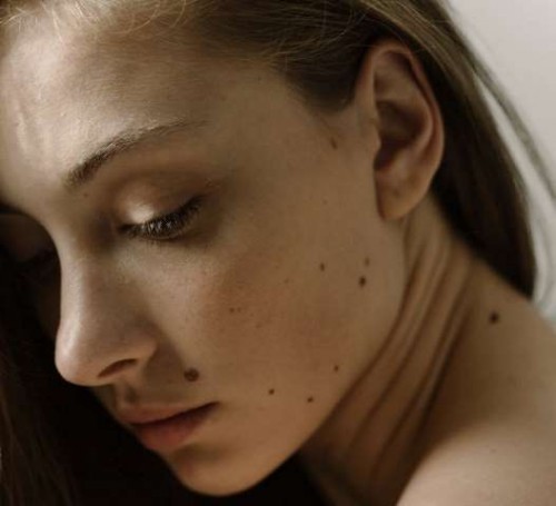 5 Cara Menghilangkan Tahi Lalat Secara Alami