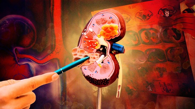 Gagal Ginjal Akut Pada Anak, Bisakah Sembuh Total?