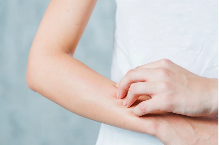 Waspada Xerosis, Kulit Kering yang Bisa Berujung Pruritus