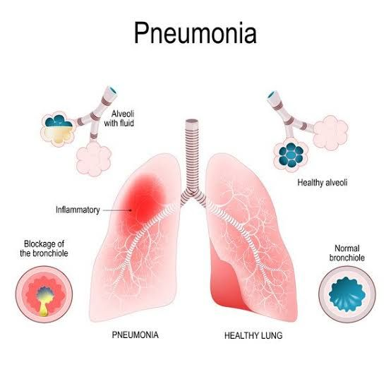 Pneumonia Penyebab Gejala Dan Cara Mengobati