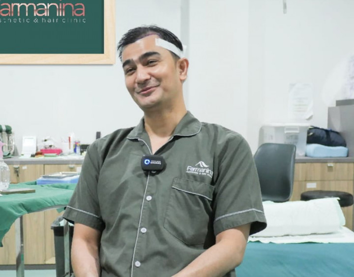 Mulai Tak Pede di Depan Kamera, Aktor Shandy Sjariff Jalani Transplantasi Rambut