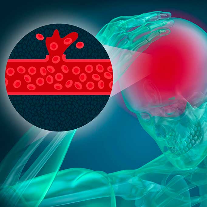 Kenali Gejala dan Penyebab Pendarahan Otak