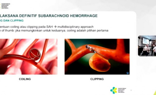 RSUP Prof. dr. I Gusti Ngoerah Bali menerapkan teknologi Coiling dan Clipping dalam penanganan stroke. (Foto: Dok. Birkom Kemenkes)