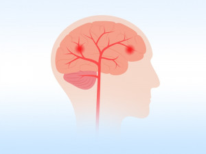 Jenis, Gejala, dan Cara Mengobati Pendarahan Otak