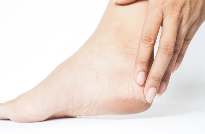 Tumit Sering Nyeri? Ini Penyebab, Gejala, dan Cara Mengobatinya