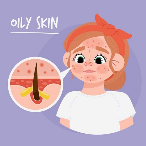 Kulit berjerawat. (Foto: Ilustrasi. Dok. Freepik.com)