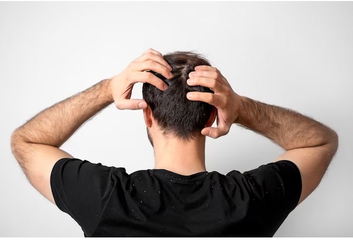 Pernah Ketombe Berlebihan? Bisa Jadi Kamu Mengalami Kondisi Ini