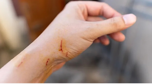 Cat Scartch Disease, Cakaran Kucing yang Menular ke Manusia