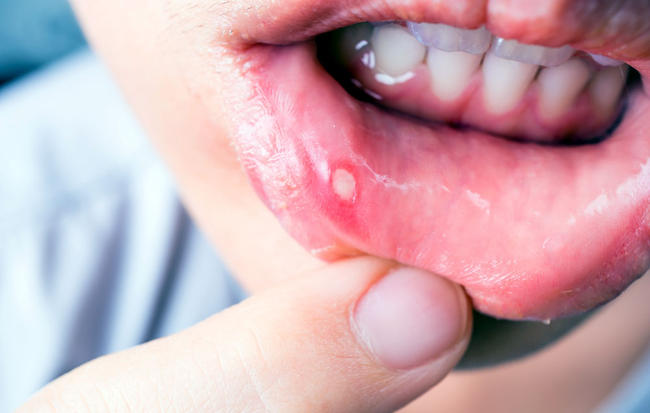 4 Langkah Mengatasi Sariawan dengan Cara Alami (Foto: shutterstock)