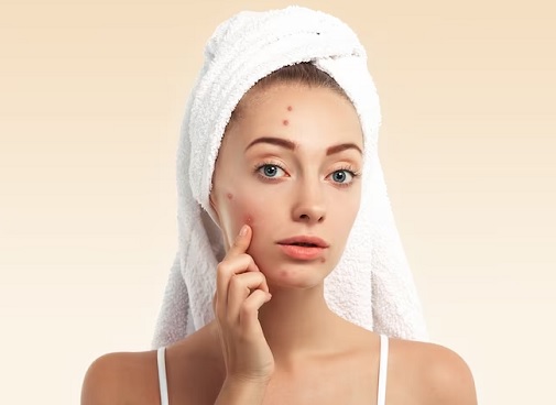 Usir Jerawat dengan 5 Perawatan Kulit Buatan Sendiri