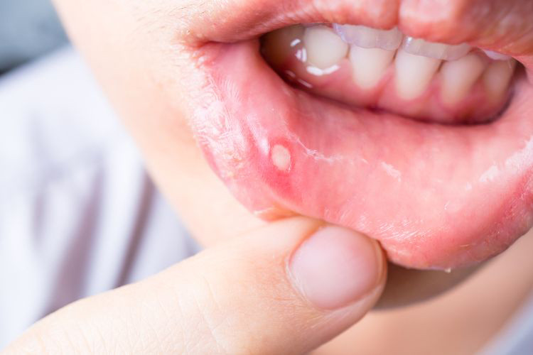 Konsumsi Air Putih dan Vitamin Kurangi Potensi Panas Dalam dan Sariawan