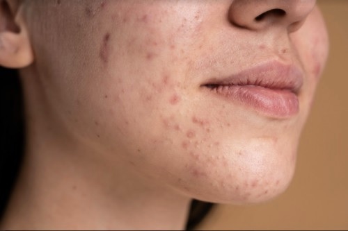 Fungal Acne Penyebab Ciri Ciri Dan Cara Menanganinya 