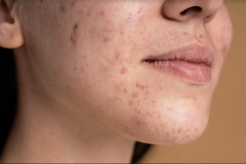 Fungal Acne: Penyebab, Ciri-Ciri, dan Cara Menanganinya