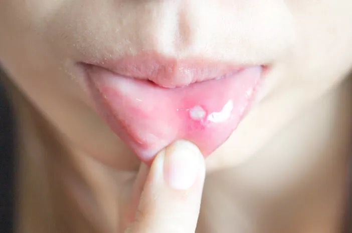 Sering Sariawan saat Puasa? Ini 6 Cara Mengobatinya