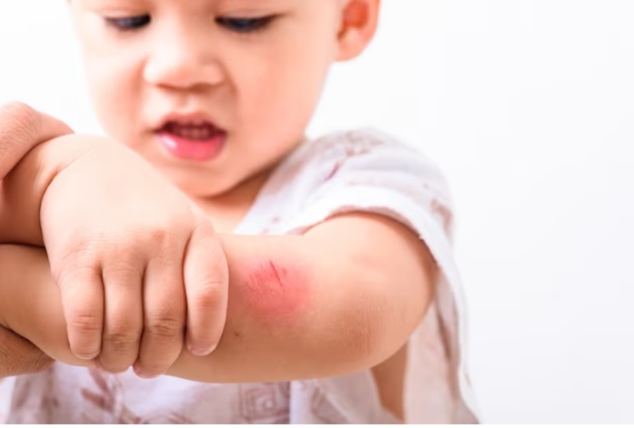 Saat si Kecil Terluka, Ini Langkah Pertama yang Harus Kamu Lakukan