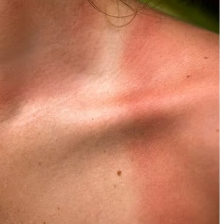 Awas Terkena Sunburn! Ini Penjelasan dan Cara Mencegahnya
