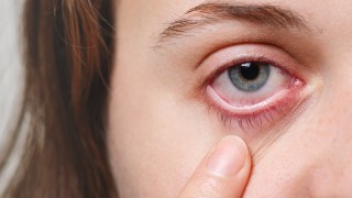 Dokter RSA UGM Ungkap Cara Cegah Penularan Mata Belekan