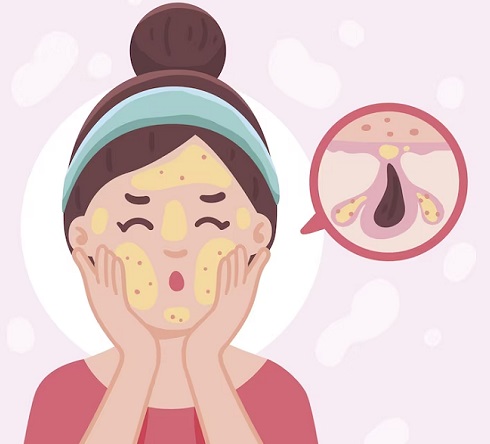 Tantangan terbesar memiliki kulit berminyak adalah menjaga keseimbangan kelembapannya. (Foto: Ilustrasi. Dok. Freepik.com)