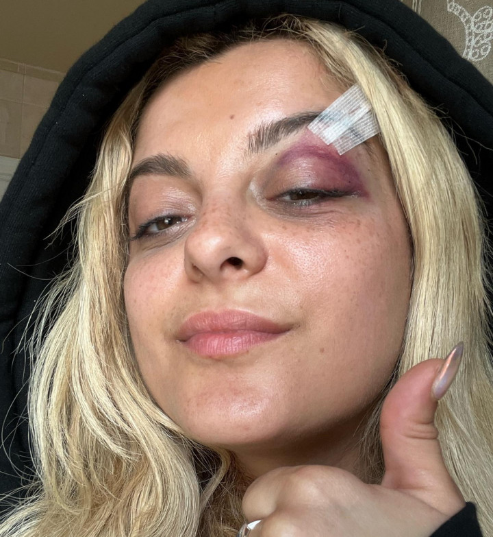 Kondisi Bebe Rexha Setelah Dilempar Ponsel Saat Manggung