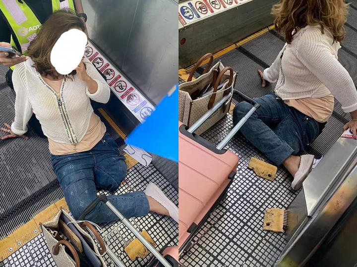Ngilu! Kaki Perempuan Ini Harus Diamputasi Akibat Terjepit Eskalator Bandara
